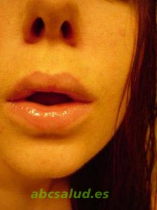 Encías inflamadas